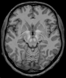 MRI Template - T1 + T2