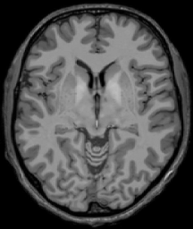 MRI Template - T1 + T2