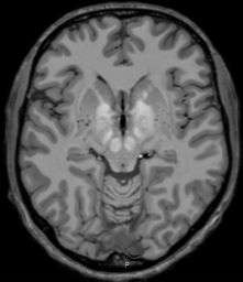 MRI Template - T1 + T2